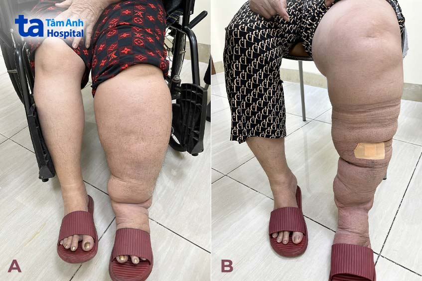 Chân trái bệnh nhân to gấp đôi chân phải và thu nhỏ 50% kích cỡ sau 10 ngày phẫu thuật nối tĩnh mạch - mạch bạch huyết