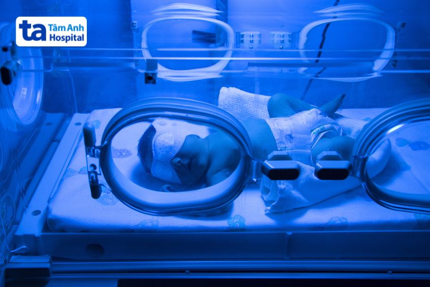 Chiếu đèn điều trị vàng da cho trẻ sơ sinh