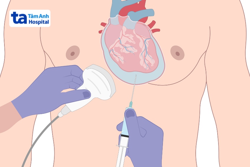 chọc dò dịch màng tim