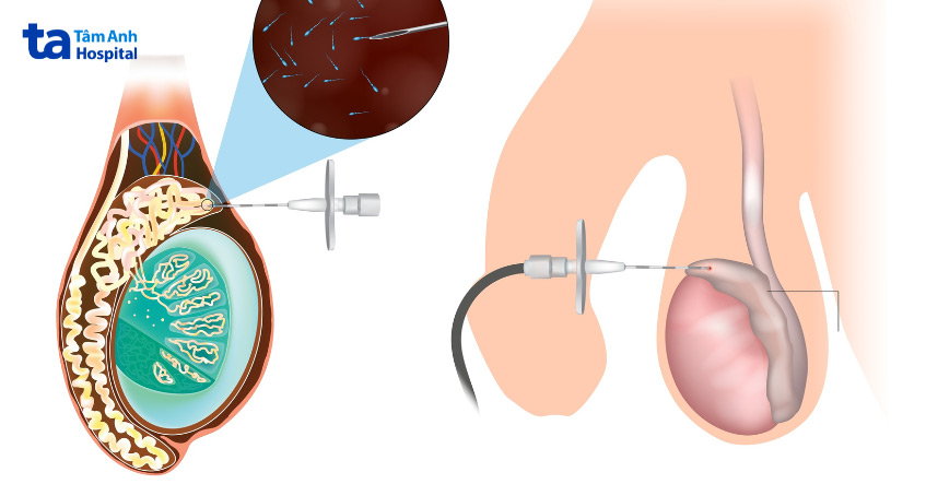 Chọc hút tinh trùng từ mào tinh qua da (PESA)