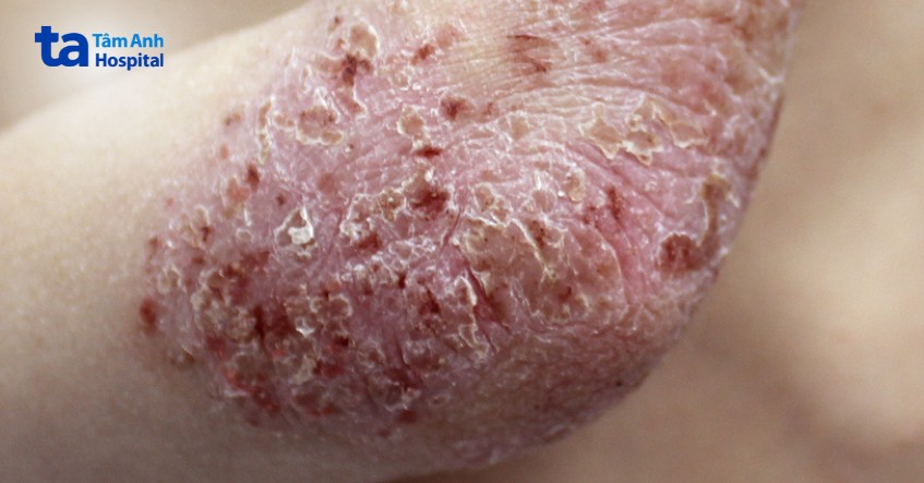 chốc thường bị ở vị trí nào