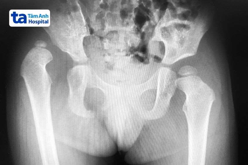 chỏm xương đùi trật ra khỏi ổ cối