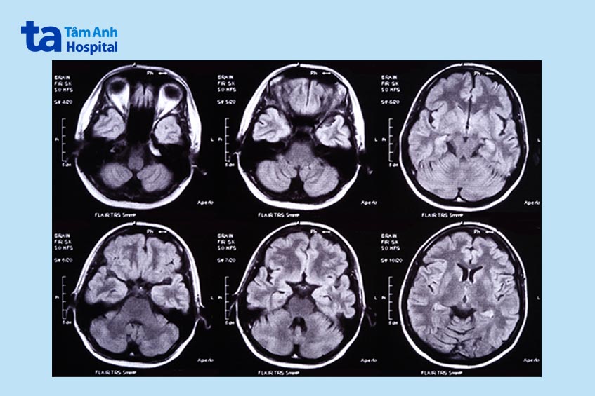 chụp ct máu tụ dưới màng cứng mãn tính