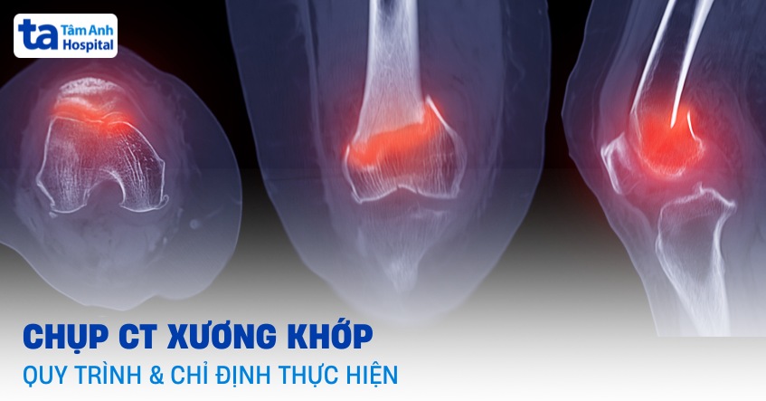Chụp CT xương khớp: Quy trình thực hiện, có rủi ro gì không?