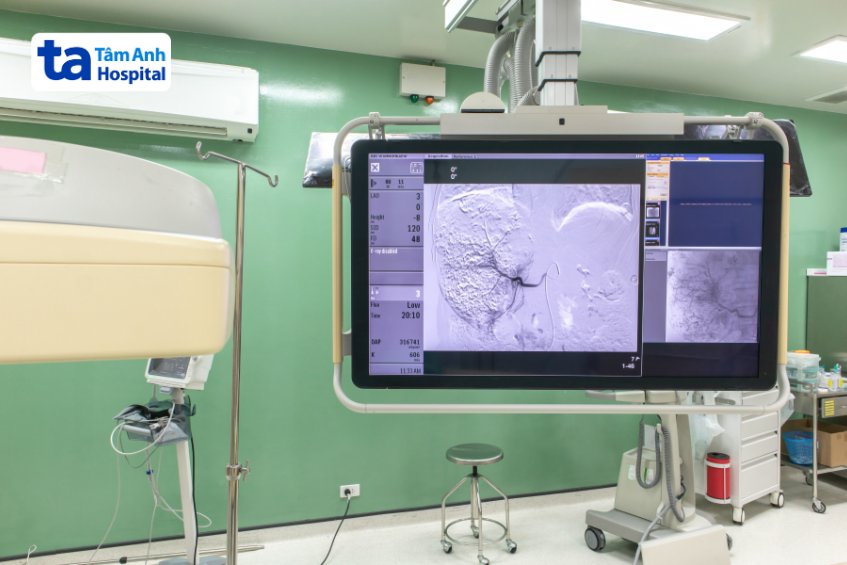 chụp mạch số hóa xóa nền dsa