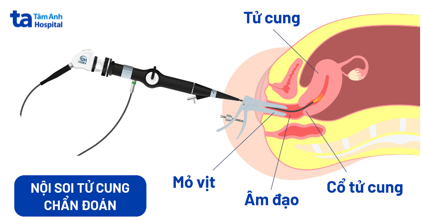 Chụp X-quang tử cung - vòi trứng thường được chỉ định khi đánh giá độ thông của vòi trứng
