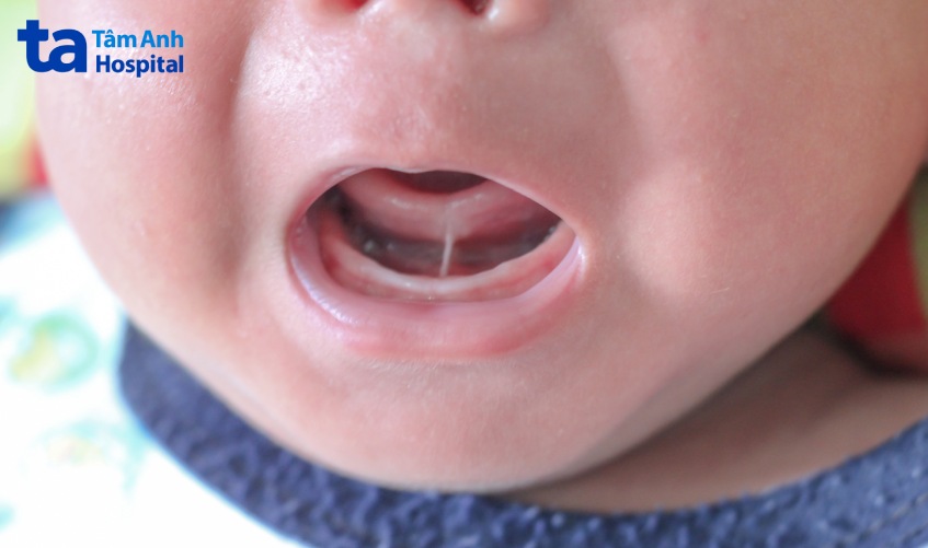 có nên cắt thắng lưỡi cho bé