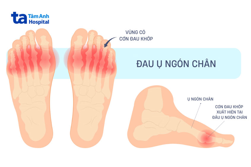 cơn đau gây ảnh hưởng đến sinh hoạt
