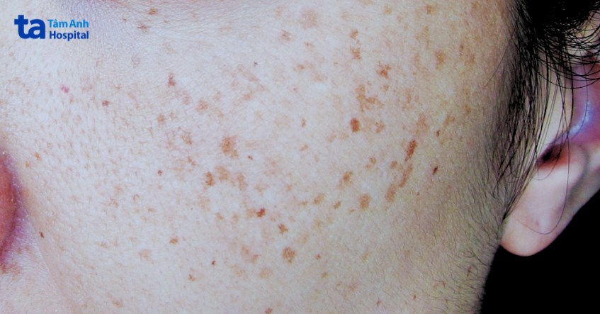 đặc điểm nhận dạng tàn nhang