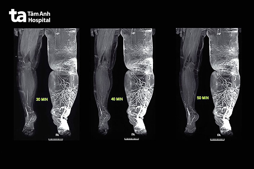Hình MRI dẫn lưu bạch huyết và dòng chảy ngược ra bàn chân, cẳng chân và đùi sau tiêm thuốc tương phản 30 phút, 40 phút, 50 phút