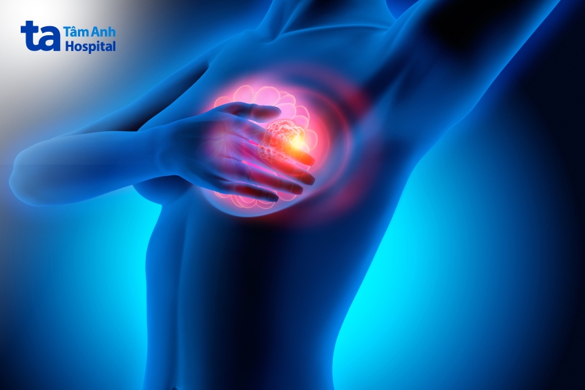 đau dai dẳng sau điều trị ung thư vú