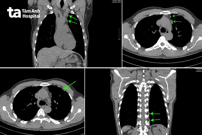 Dấu hiệu màng phổi xuất hiện nốt sần ác tính