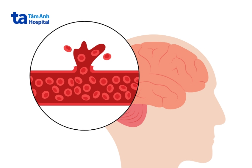 giãn mạch máu não có thể bị vỡ