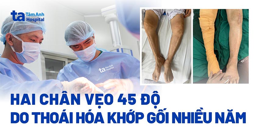Hai chân vẹo 45 độ do thoái hóa khớp gối hàng chục năm