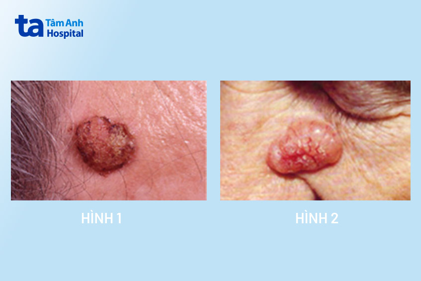 hình ảnh tình trạng ung thư da hắc tố