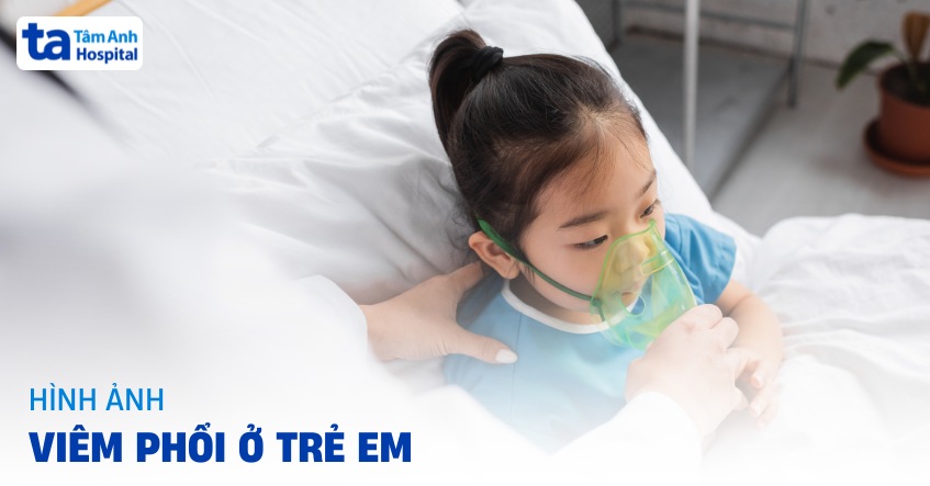 Hình ảnh viêm phổi ở trẻ em dễ nhận biết và không nên chủ quan