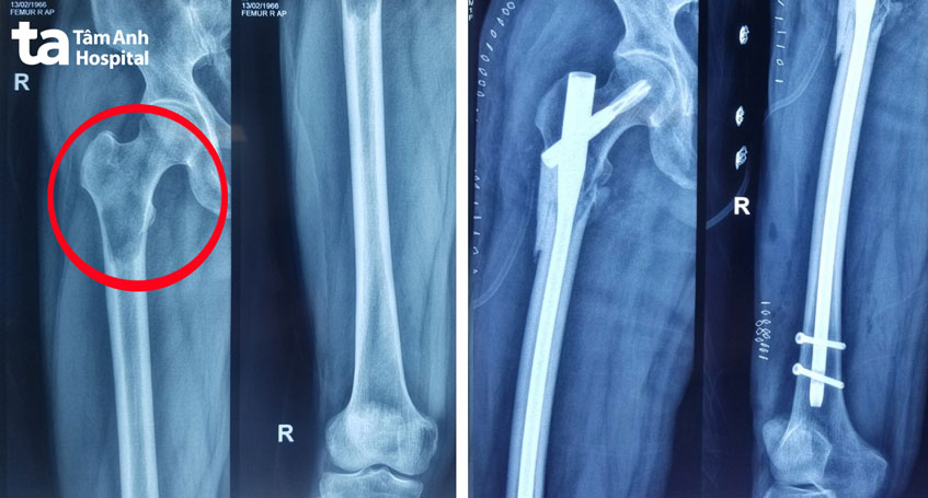 hình x quang trước và sau phẫu thuật
