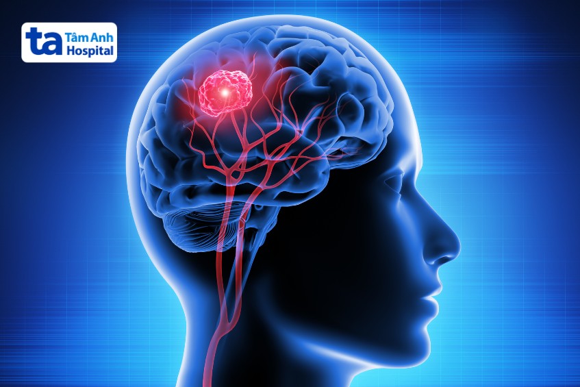 khả năng chữa trị phụ thuộc vị trí khối u não ác tính