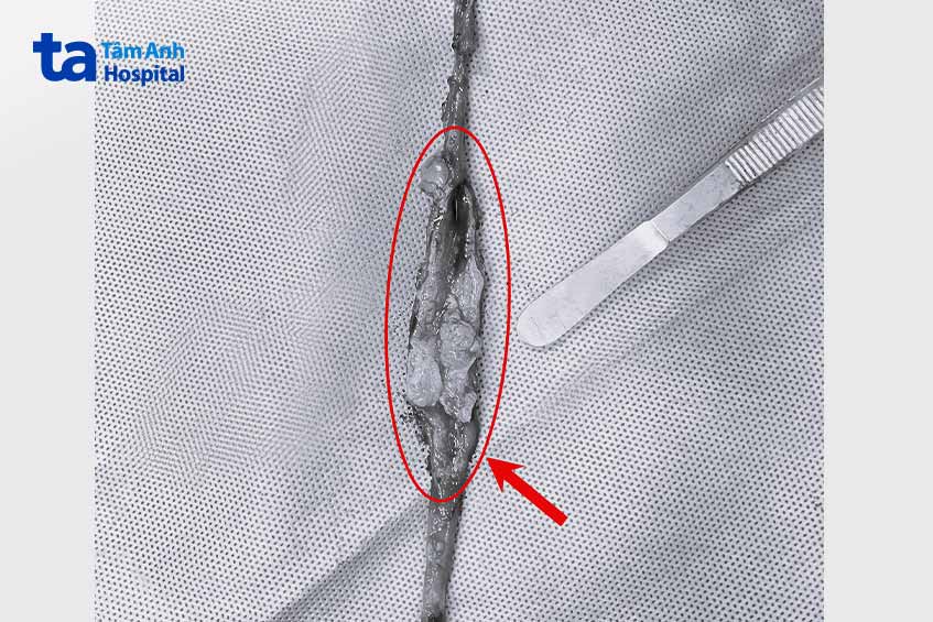 khối u ác tính trong niệu quản bên phải