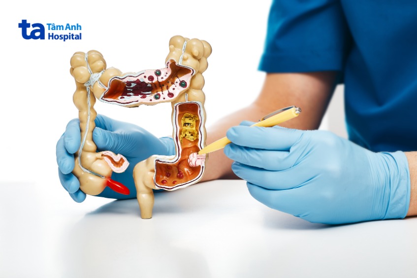 khối u mô đệm đường tiêu hóa