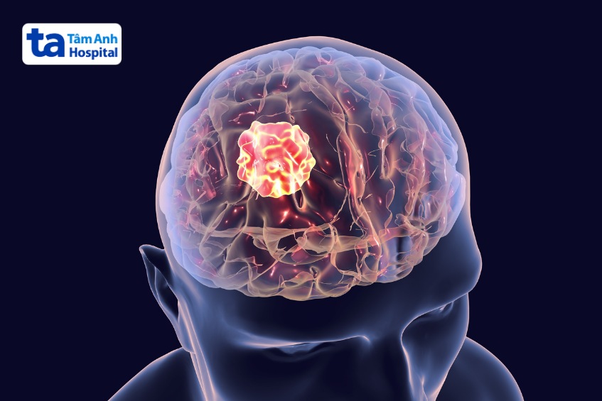 khối u não ác tính có chữa được không