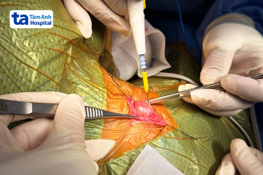 Khối u ở cổ được bác sĩ bóc tách