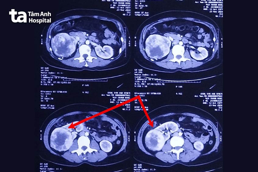 khối u thận trên ảnh ct