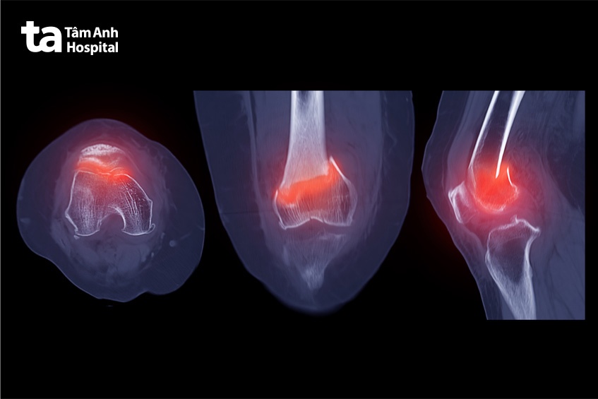 kỹ thuật CT đầu gối