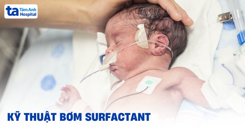 Kỹ thuật bơm Surfactant trong điều trị suy hô hấp sơ sinh
