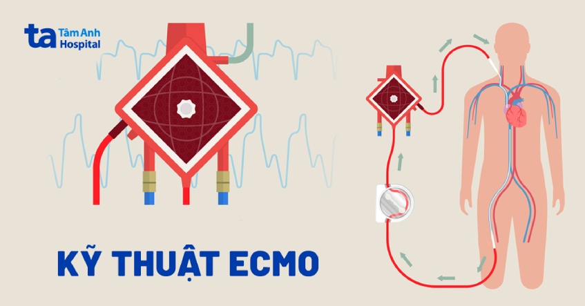 Kỹ thuật ECMO là gì? Có tác dụng gì? Chỉ định và chống chỉ định