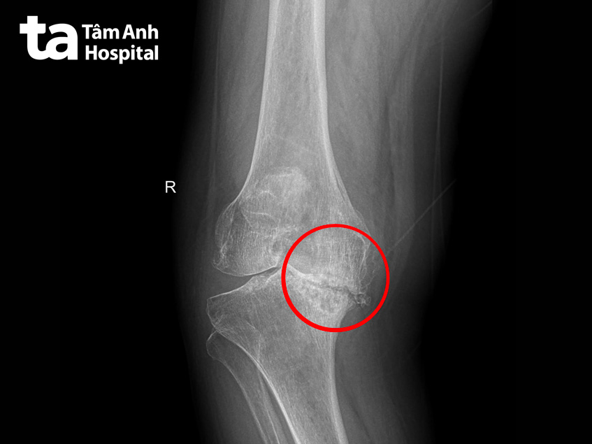 lớp sụn khớp gối gần như không còn