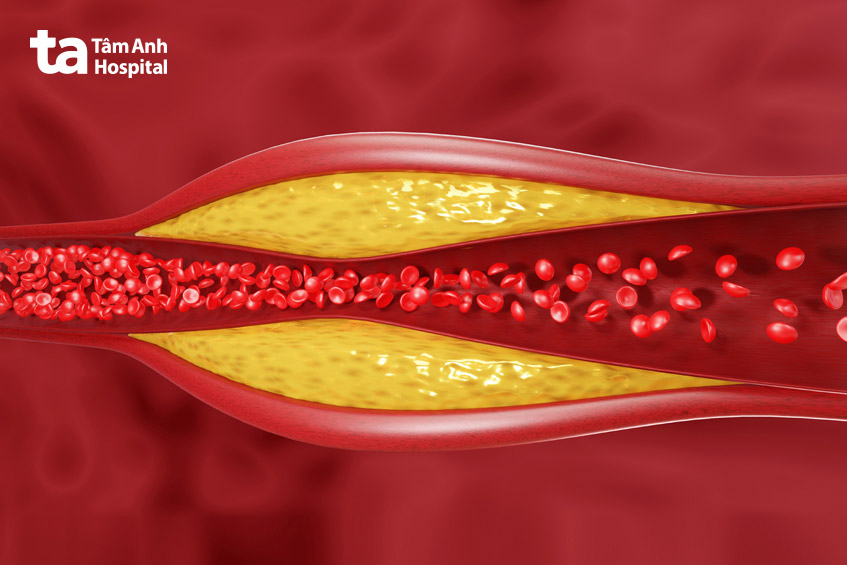 Mảng bám trong lòng động mạch do HDL-C giảm và LDL-C tăng gây hẹp hoặc tắc mạch vành