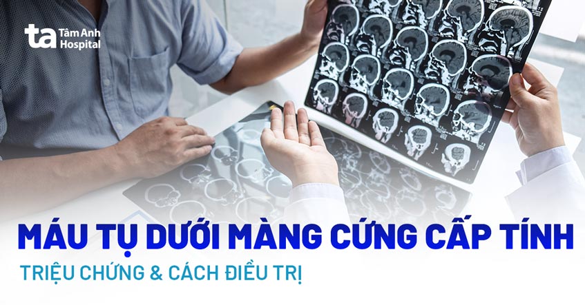 Máu tụ dưới màng cứng cấp tính: Triệu chứng, nguyên nhân và điều trị