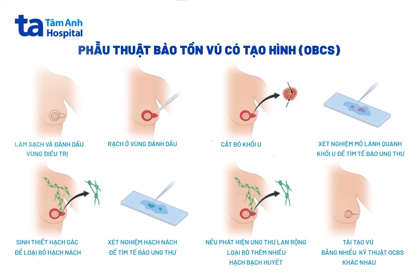 mổ bảo tồn vú có tạo hình