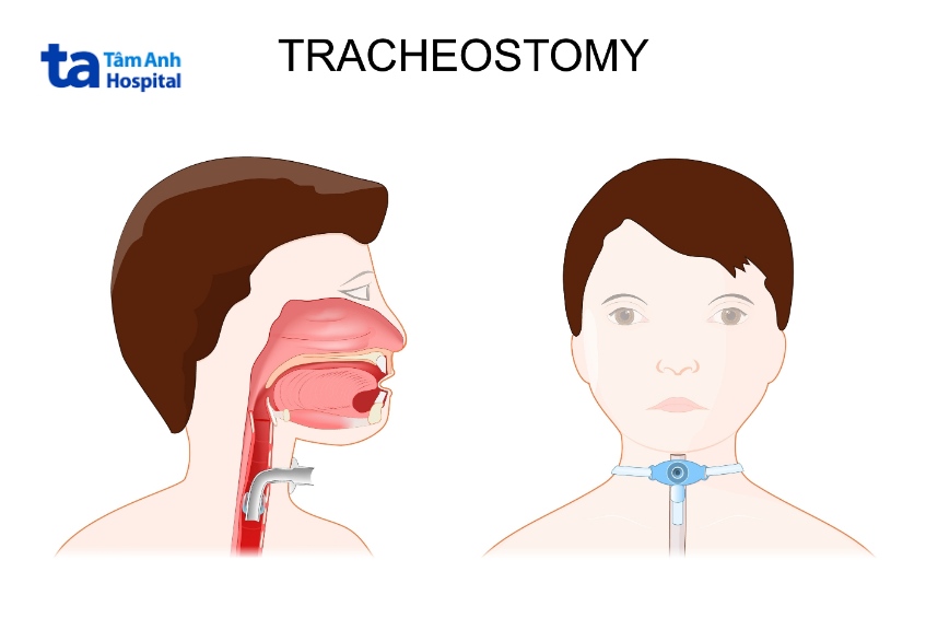 Mở khí quản là một trong những phương pháp phù hợp