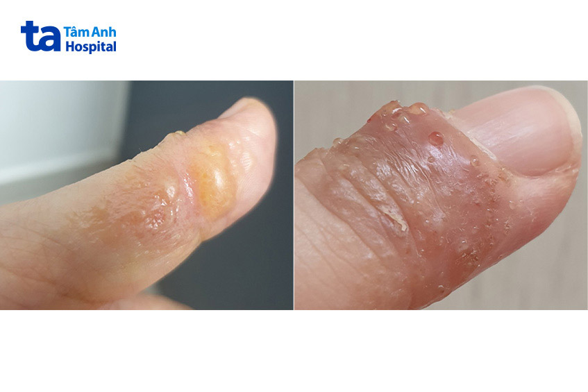 mụn nước và phồng rộp xuất hiện trên tay