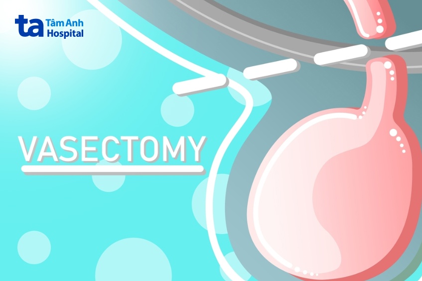 nam giới có nên lựa chọn thắt ống dẫn tinh