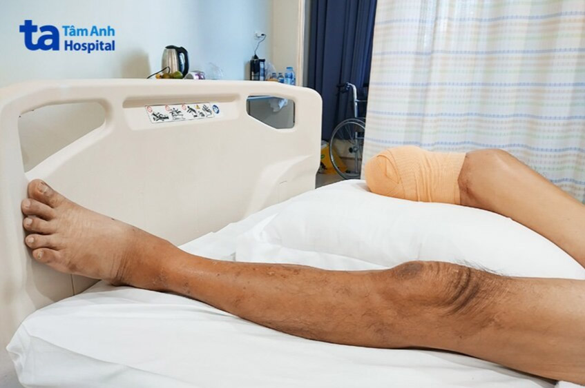 Người bệnh sau phẫu thuật cắt cụt cẳng chân