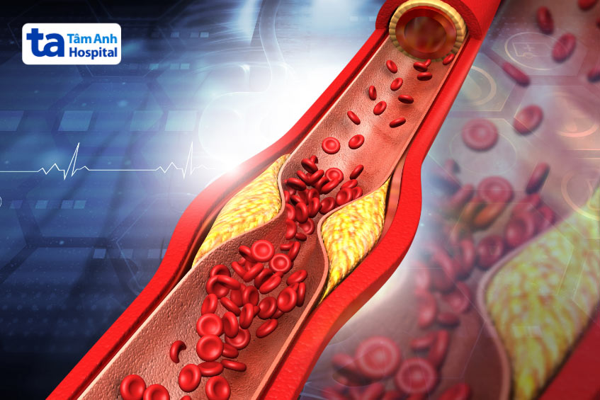Nguy cơ xơ vữa động mạch nếu cholesterol trong máu tăng quá cao