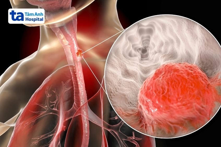 nguyên nhân gây hẹp thực quản