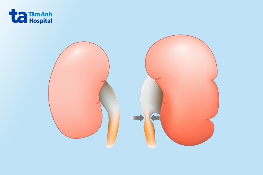 nguyên nhân thận ứ nước