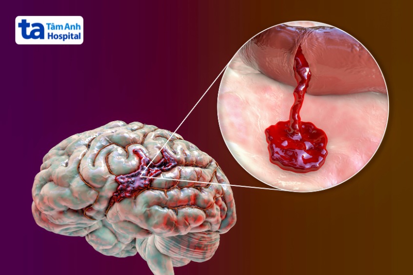 nguyên nhân vỡ mạch máu não nguy hiểm