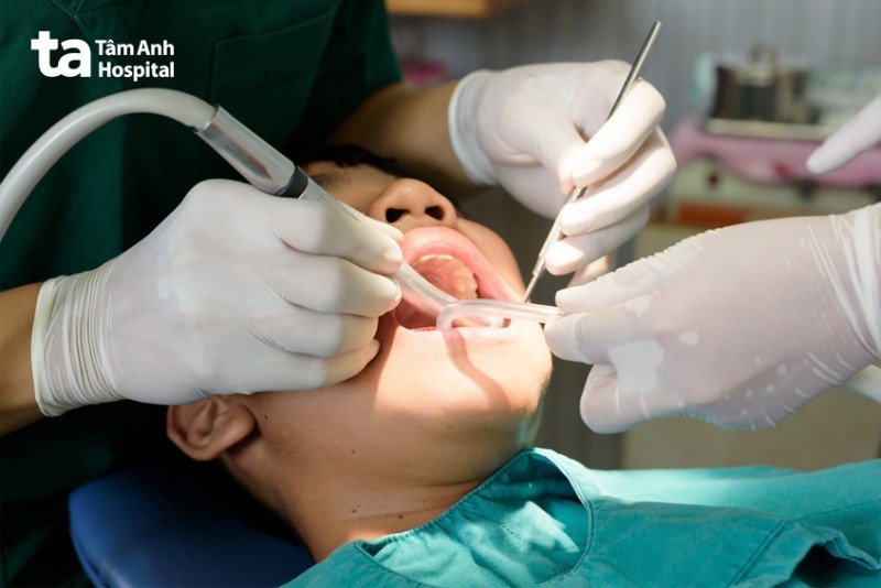 Nhổ răng khôn công nghệ Piezotome nhẹ nhàng, êm ái tại Bệnh viện Đa khoa Tâm Anh TP.HCM