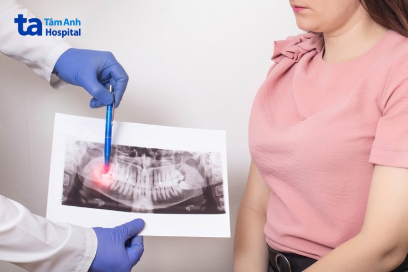 Nhổ răng khôn bằng sóng siêu âm có tốt không?
