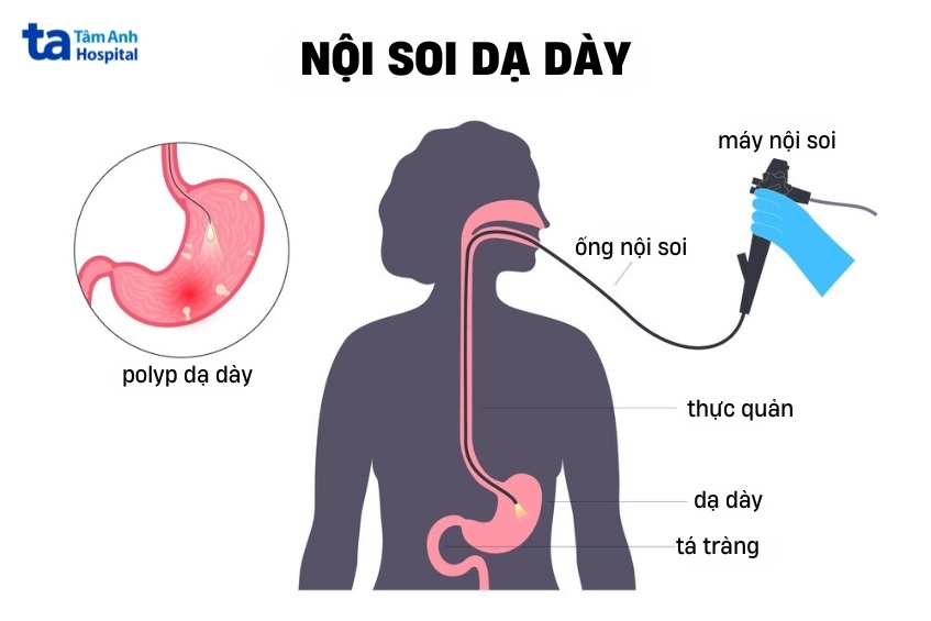 nội soi chẩn đoán giai đoạn 0 ung thư dạ dày