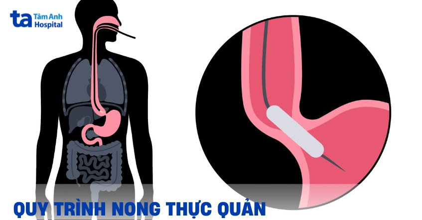 Nong thực quản: Quy trình thực hiện và đối tượng được chỉ định