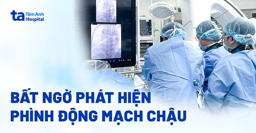 Phát hiện phình động mạch chậu dù không triệu chứng