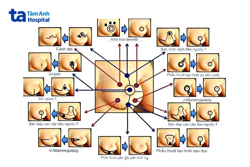 bảo tồn vú có tạo hình có đau không