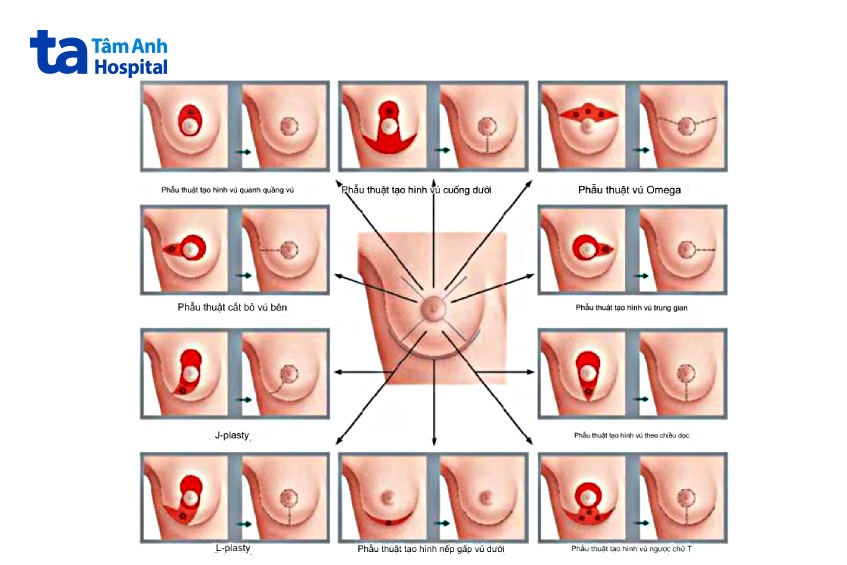 phẫu thuật bảo tồn vú OBCS