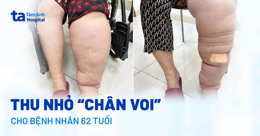 Phù chân voi sau nhiều năm điều trị ung thư